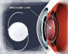 An intraocular lens, with the thin curved arms that hold it in position inside the eye.