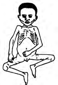 A child with marasmus: ribs showing under the skin, arms and legs as thin as sticks, and a face that looks like an old person's.
