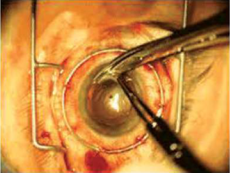 During corneal transplantation, the surgeon works on the damaged cornea with fine instruments while a wire frame holds the eye steady.