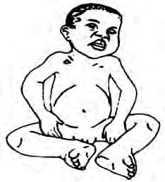 A child with kwashiorkor: a swollen belly, puffy arms and legs, and a round, moon-like face.