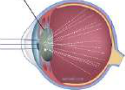 A cloudy lens scatters the light entering the eye, so the rays spread over the retina instead of meeting at one point.