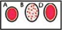 B-ve: only the B drop is grainy, and the smooth D drop shows there is no Rh factor.