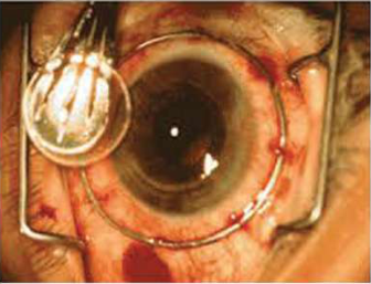 The healthy cornea in place, held by a ring of fine stitches around its edge.