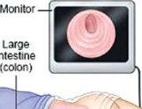 During colonoscopy, the inside of the large intestine (colon) appears on a monitor for the doctor to study.
