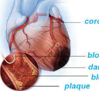Figure 5.10 Condition of a heart attack: plaque has narrowed the coronary artery, a blood clot has formed on the plaque, blood flow beyond it is blocked, and the heart tissue below is damaged.