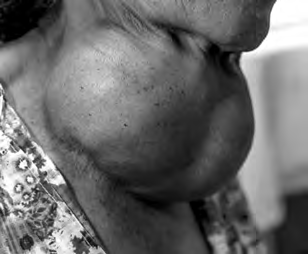 Goitre: the swollen thyroid gland forms a large lump hanging at the front of the neck.