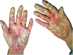 Skin of the hands damaged by repeated contact with poisonous chemicals