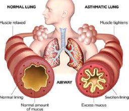 A normal airway beside the swollen, narrowed airway of an asthmatic lung: chemicals in the air can lead to breathing diseases like this.