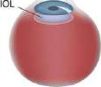 An intraocular lens (IOL) is implanted where the natural lens used to be.